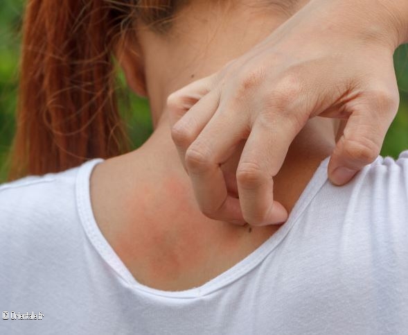 Choc anaphylactique du aux moustiques et tiques Choc anaphylactique du aux moustiques et tiques