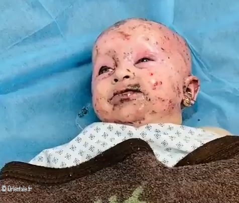 Un bébé palestinien blessé par du phosphore Un bébé palestinien blessé par du phosphore